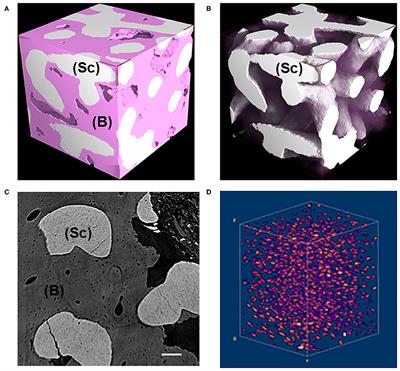 Case Report: Histological and Histomorphometrical Results of a 3-D Printed Biphasic Calcium Phosphate Ceramic 7 Years After Insertion in a Human Maxillary Alveolar Ridge